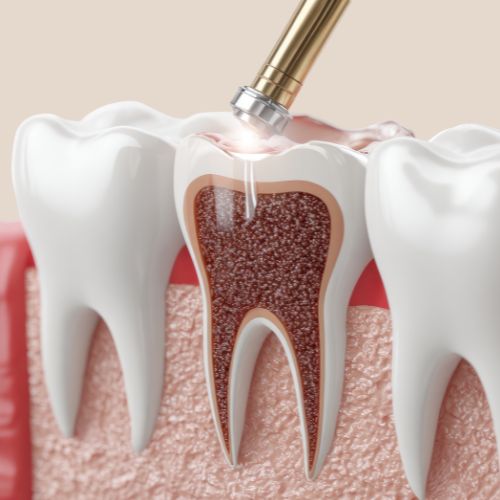 tratamiento laser harmonie1